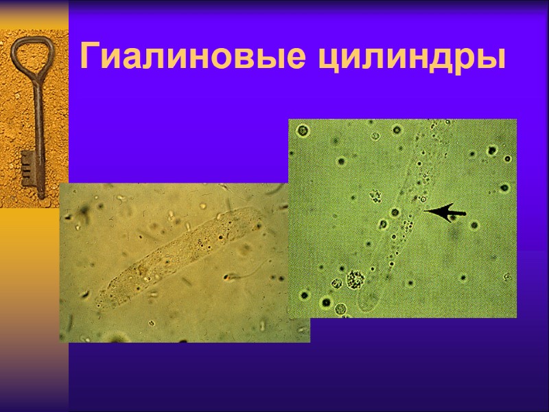 Гиалиновые цилиндры